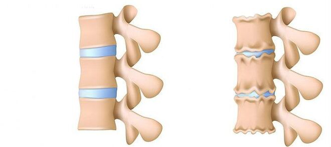 Kas ir osteohondroze