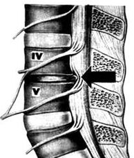 X -Ray attēls no Osteohondrozes jostas departamenta