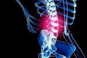 mugurkaula jostas daļas osteohondroze