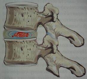Pirmais osteohondrozes posms