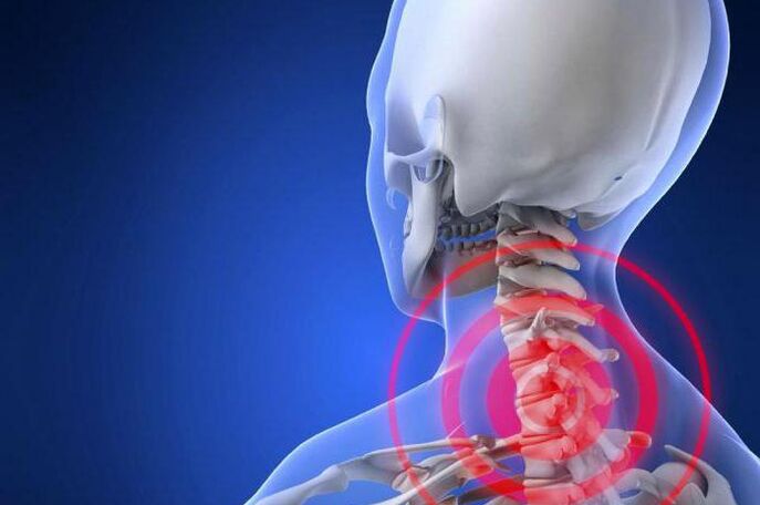 Šaušanas sāpes kaklā ir agrīns dzemdes kakla osteohondrozes simptoms